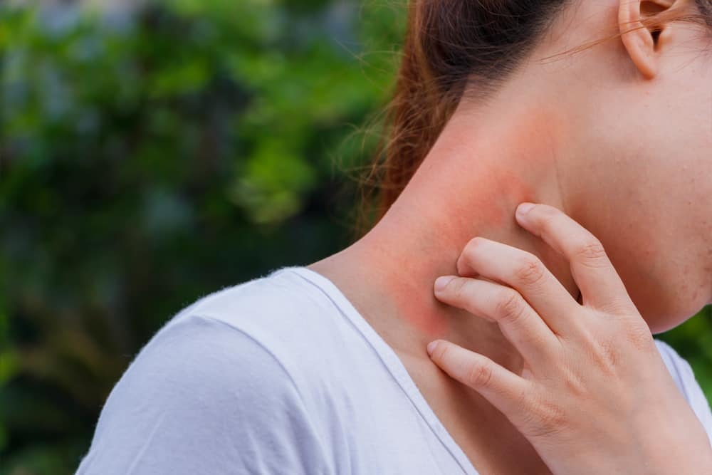 בנוסף לגירוד, אלו תסמינים נוספים של אלרגיות בעור שאתה צריך לדעת