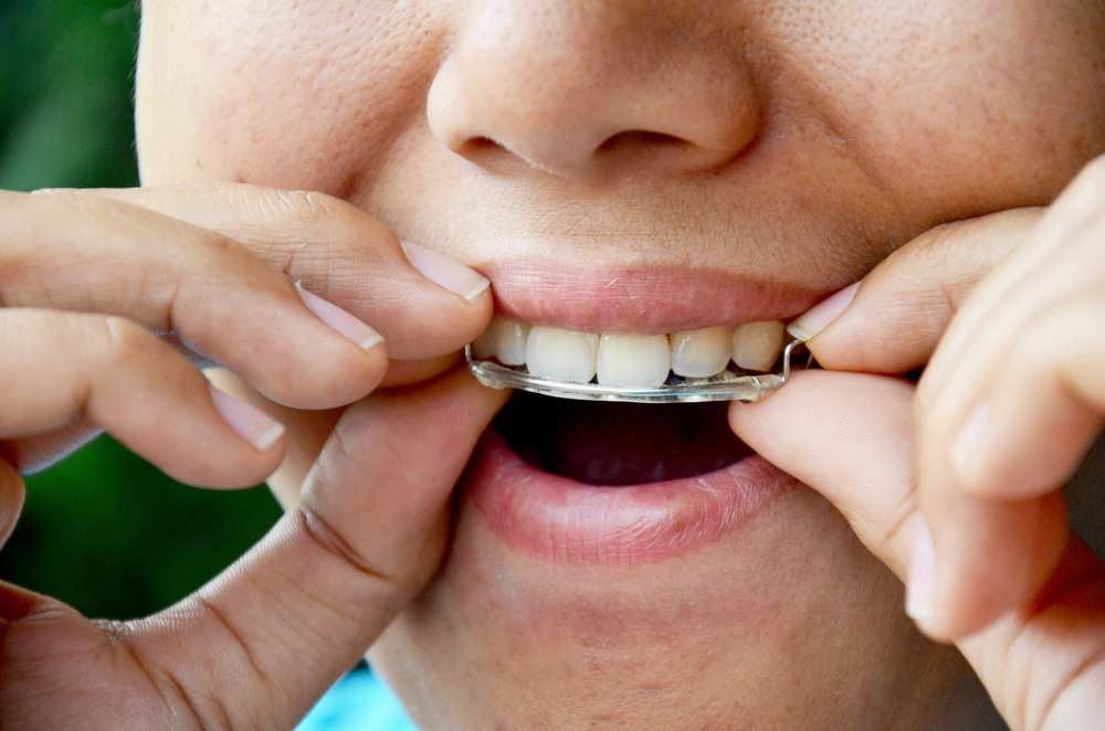האם לאחר הסרת הפלטה יש צורך להשתמש במחזיק שיניים?