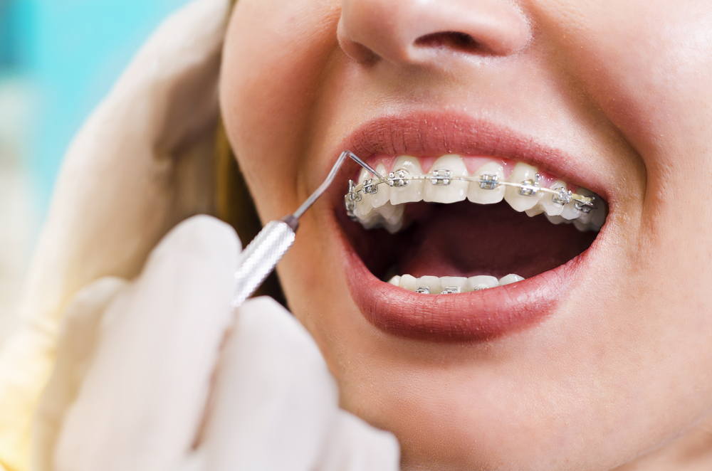 Înainte de a instala aparatul dentar, citiți mai întâi aceste 5 fapte importante