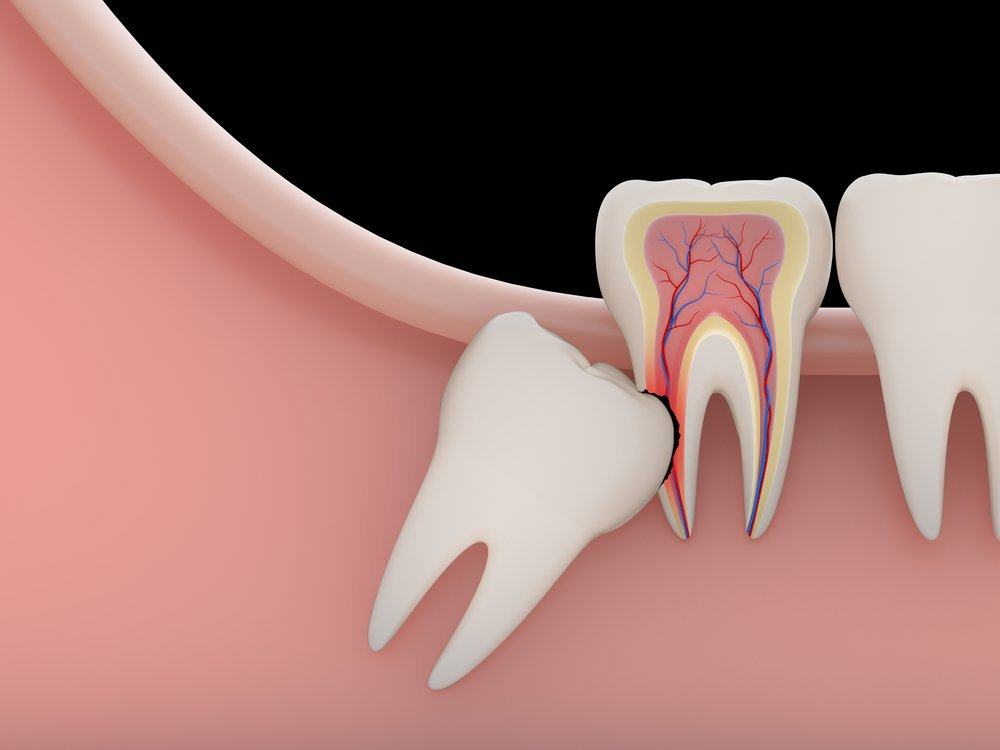 מדוע צומחות שיני בינה חדשות בבגרות?