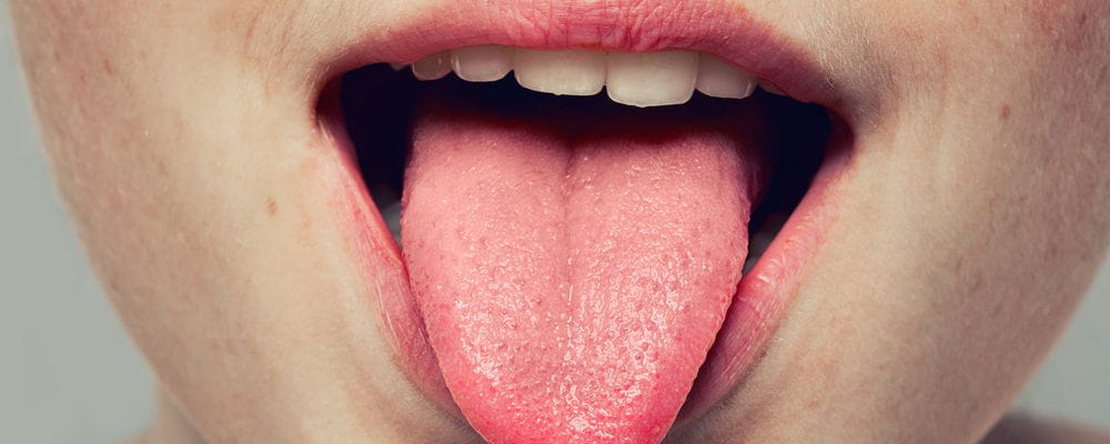 노란 혀를 유발하는 7가지 건강 상태