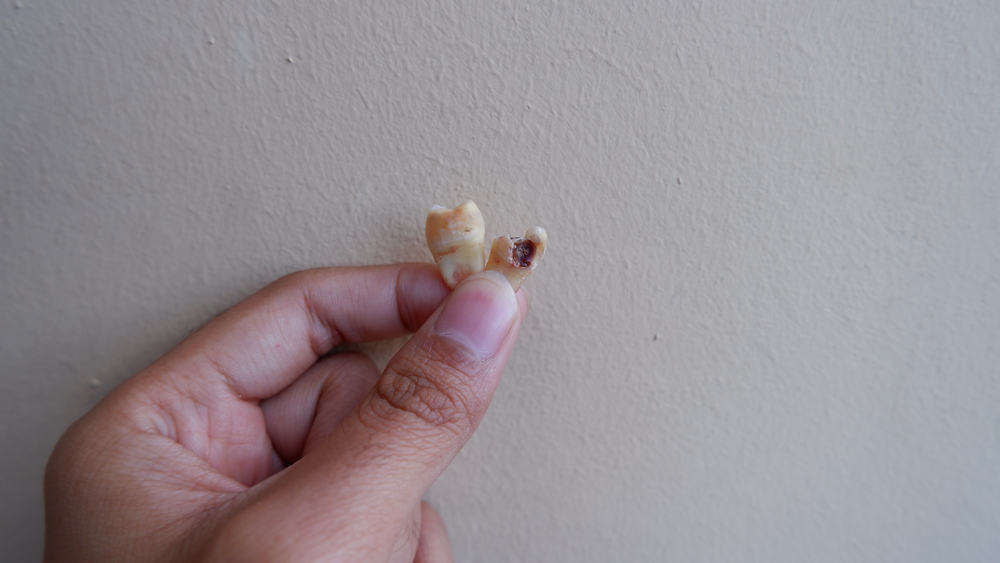 조심해야 할 죽은 치아의 원인, 치료할 수 있습니까?