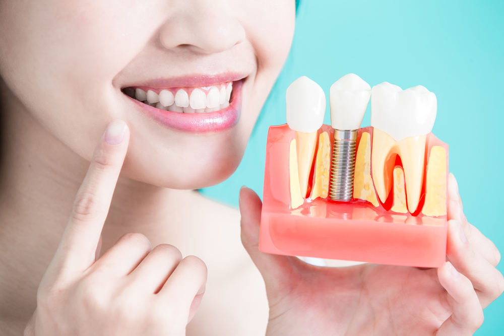 Ознайомтеся з процедурою імплантації зубів, які її переваги?