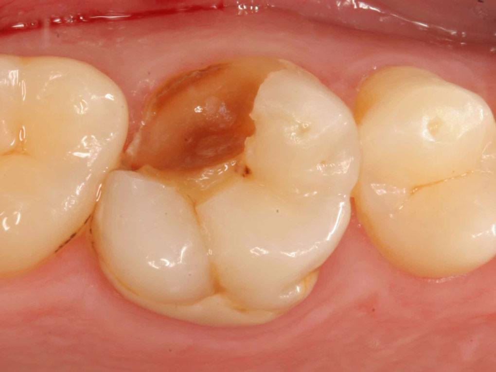 치아가 갈라지는 원인은 무엇일까요?