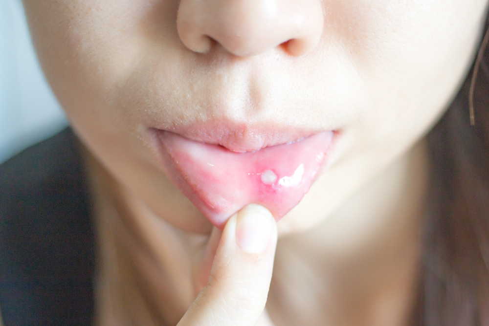 Wees niet in de war, herken het verschil tussen gewone spruw en herpes in de mond