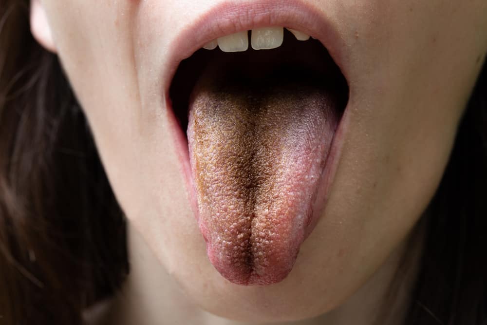 5 oorzaken van zwarte tong, van roken tot droge mondaandoeningen