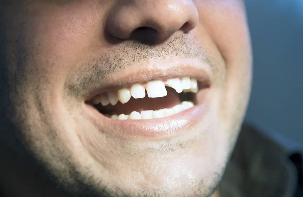 Зламані зуби, що це викликає і як це виправити?