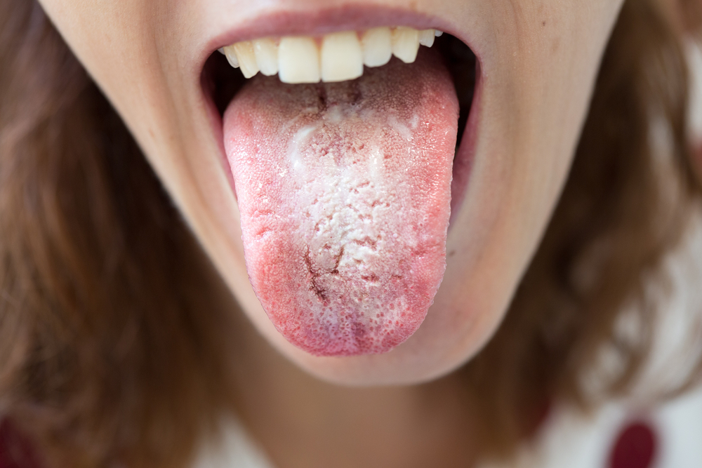4 אפשרויות של מרכיבים טבעיים כדי להתגבר על הלשון הלבנה