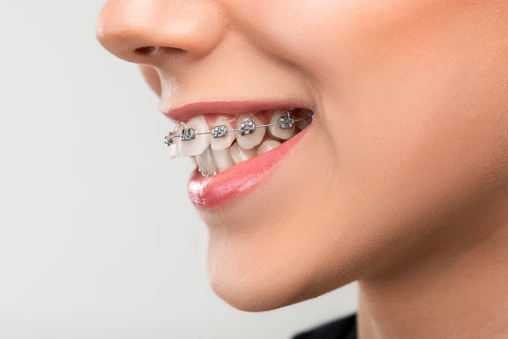 גורמים לשיניים עקומות ואפשרויות לקיבוען
