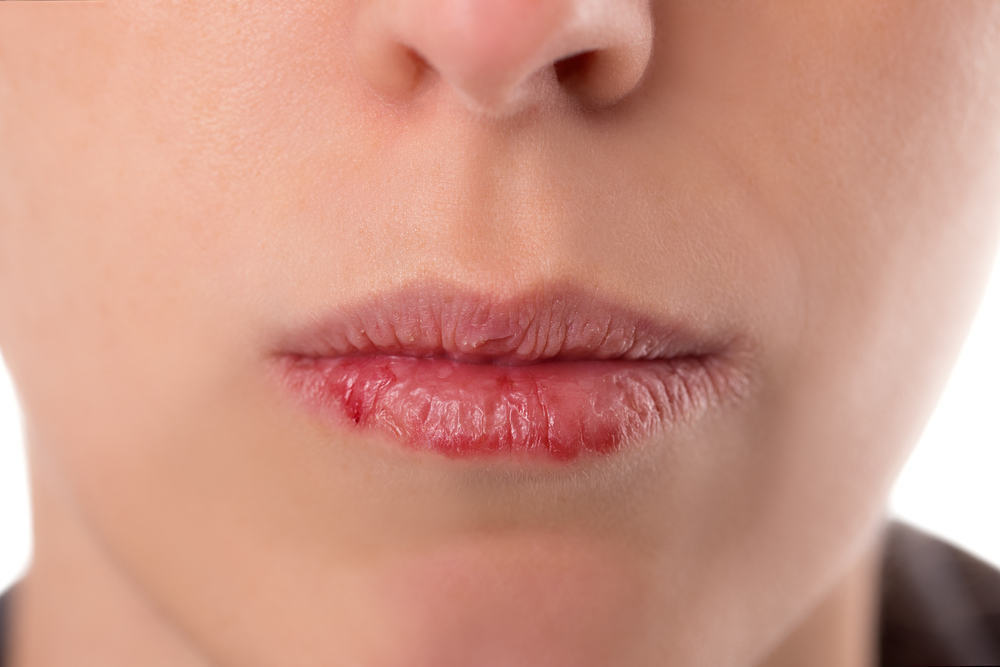 Modalități eficiente de a preveni și de a depăși buzele uscate