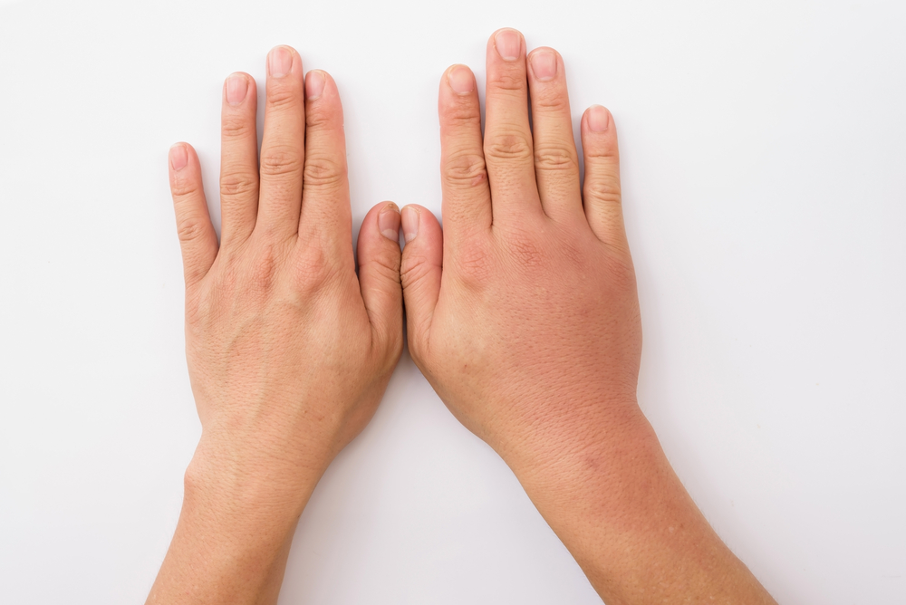 5 moduri de a depăși degetele umflate în funcție de cauză
