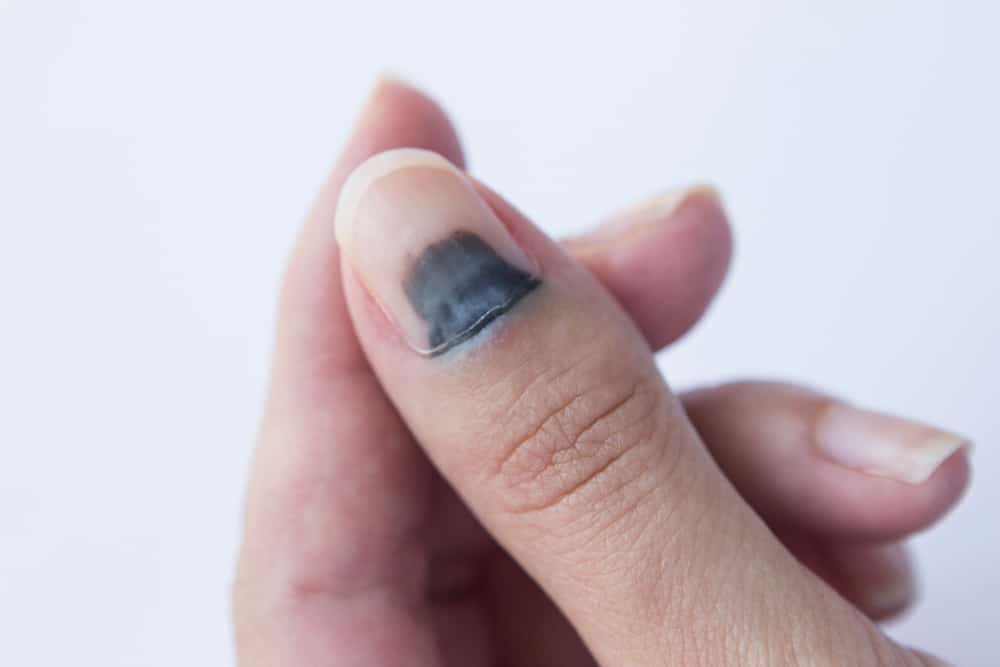 손톱의 짙은 선은 흑색종 암의 징후일 수 있습니다