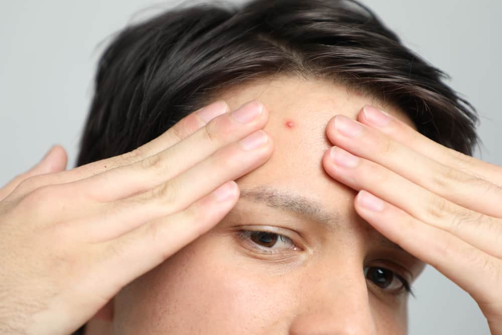 Recunoașteți cauzele acneei pe frunte și modalități eficiente de a o depăși