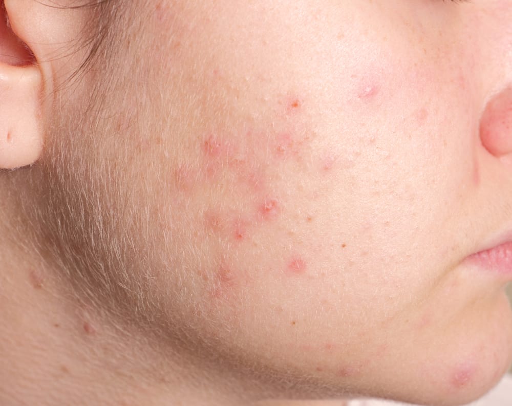 Droge huid met acne? Dit is de oorzaak en hoe het te behandelen?