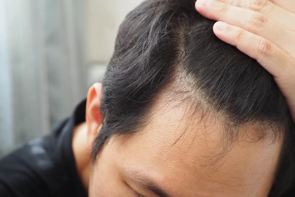 Typer av vanliga hårbottensjukdomar som du måste se upp med