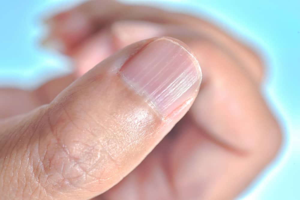 Causes des ongles ondulés qui peuvent être le signe de certaines maladies