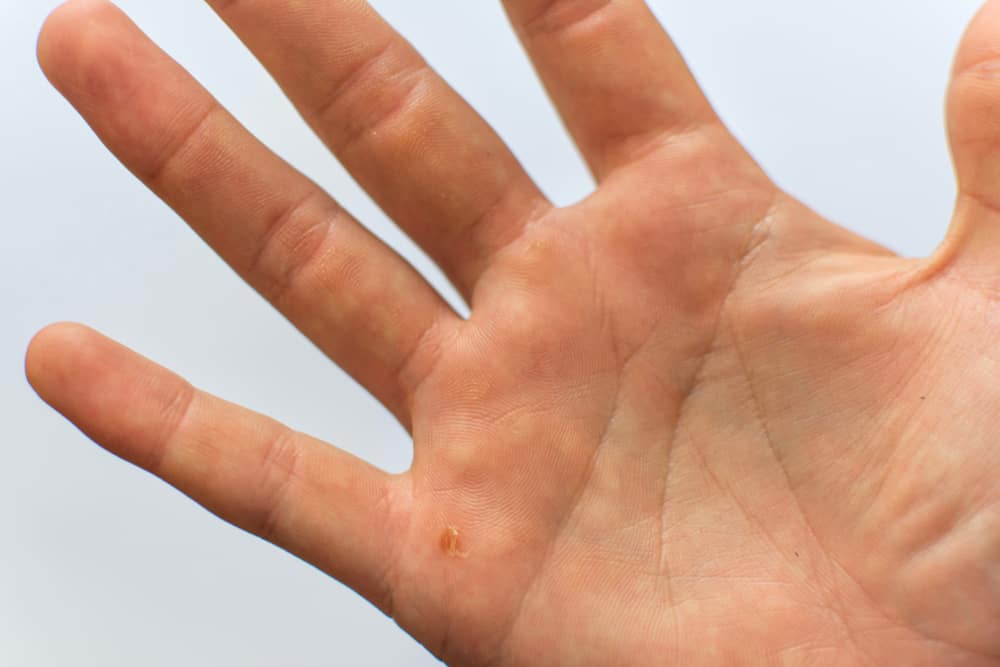 גורמים לבליטות מימיות בכפות הידיים וכיצד להתמודד איתן