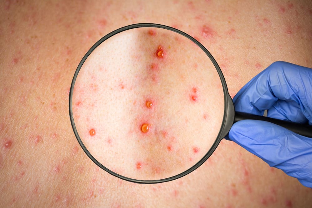 Cada tipo de viruela tiene diferentes causas, ¿cómo se trata?