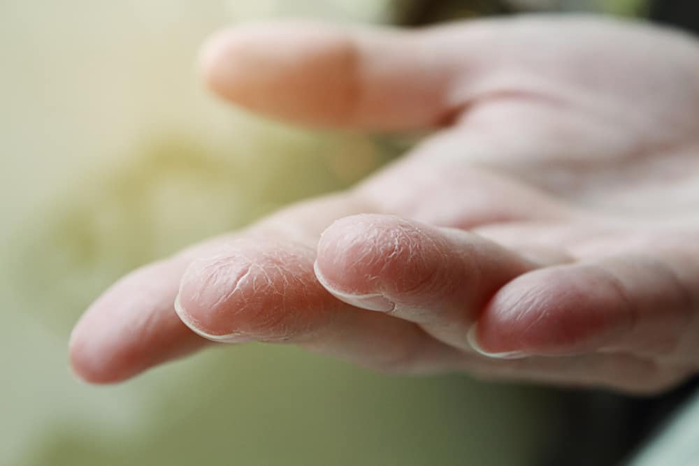 5 conditions qui pourraient faire peler votre peau