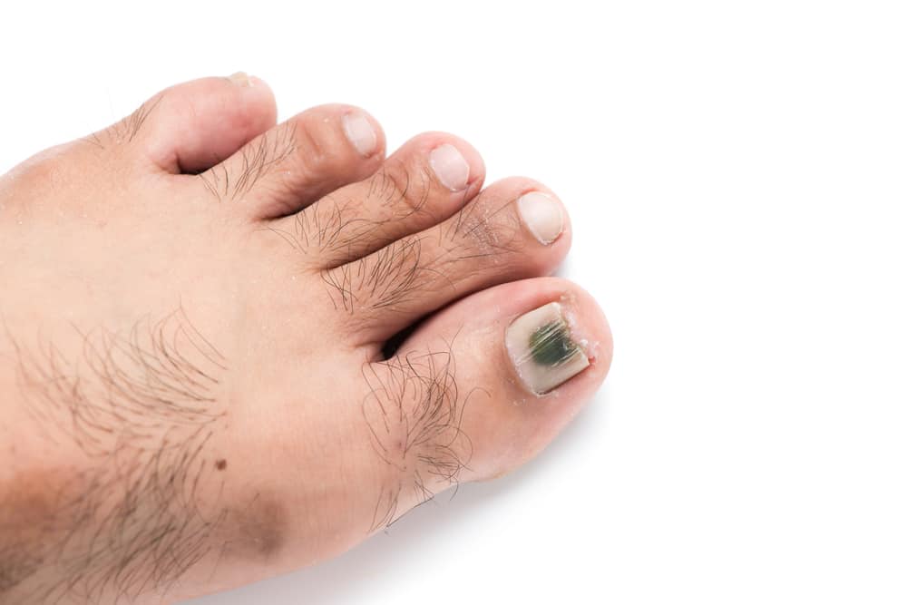 5 causes des ongles de pied devenant noirs