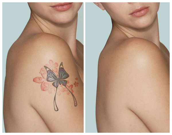 Les 3 façons les plus sûres d'enlever les tatouages