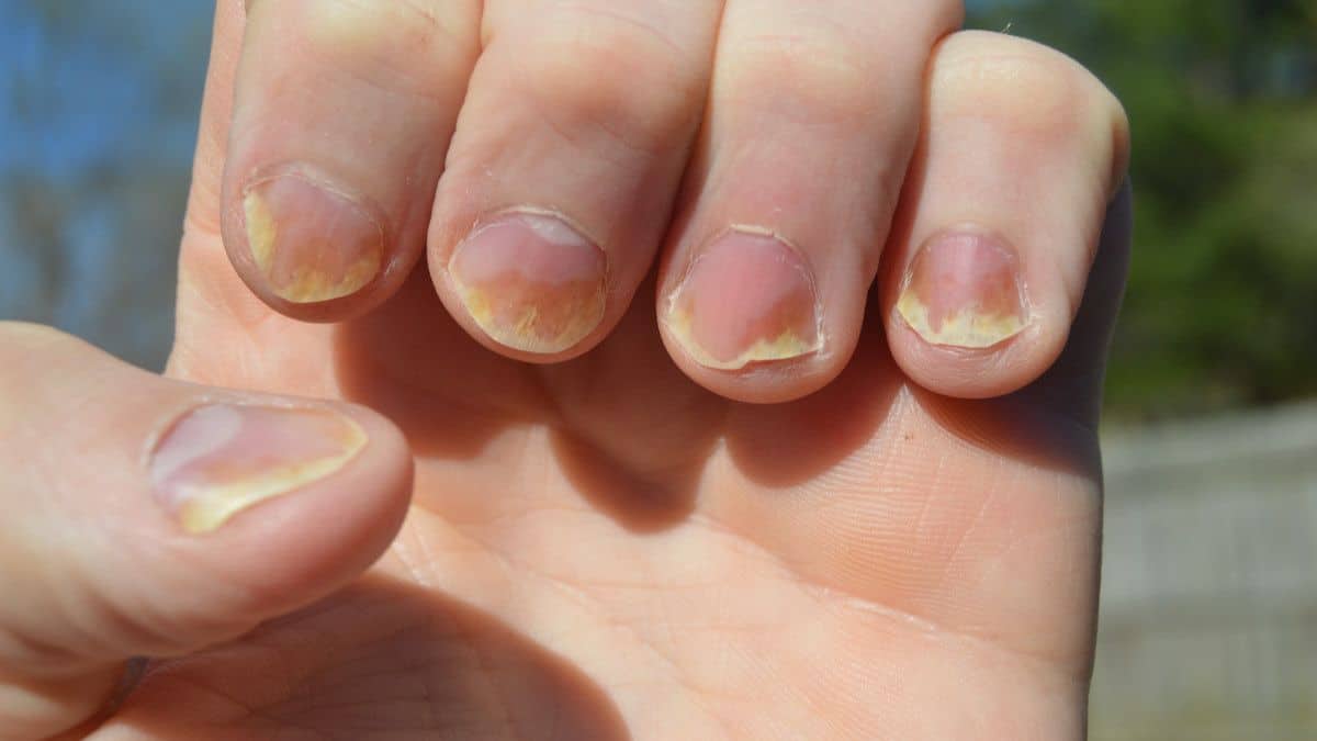 Oorzaken, symptomen en hoe psoriasis op nagels te overwinnen