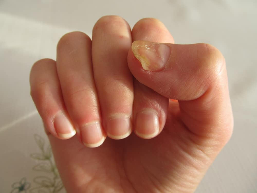 Причины пожелтения ногтей и как с этим бороться