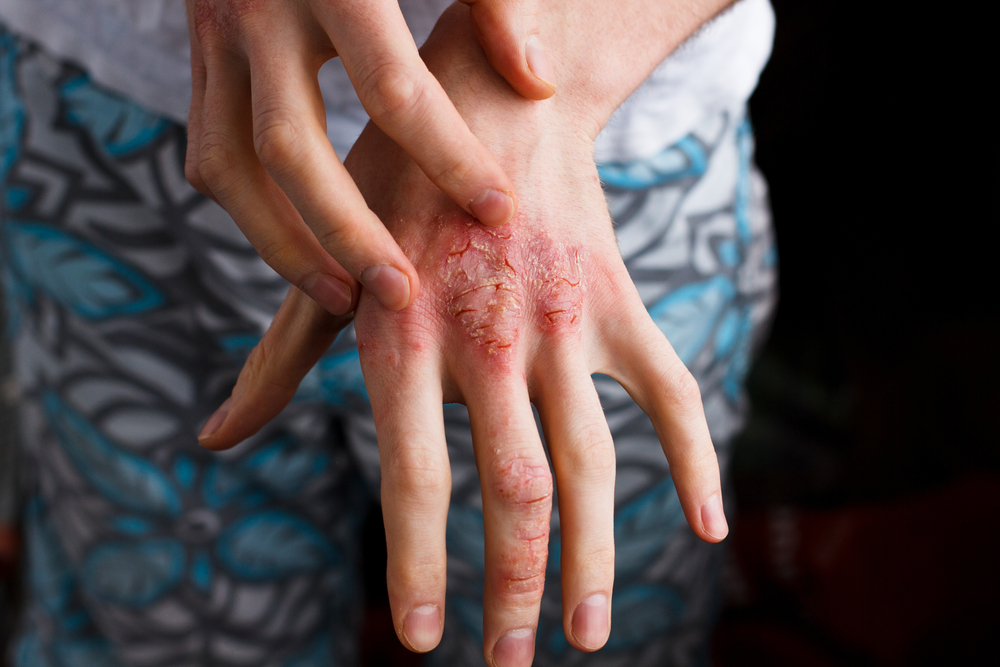 Care este diferența dintre eczema umedă și eczema uscată?