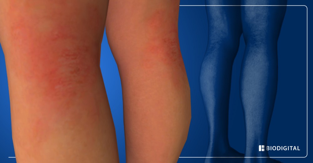 Recunoașteți și feriți-vă de simptomele de eczemă pe baza etapelor bolii