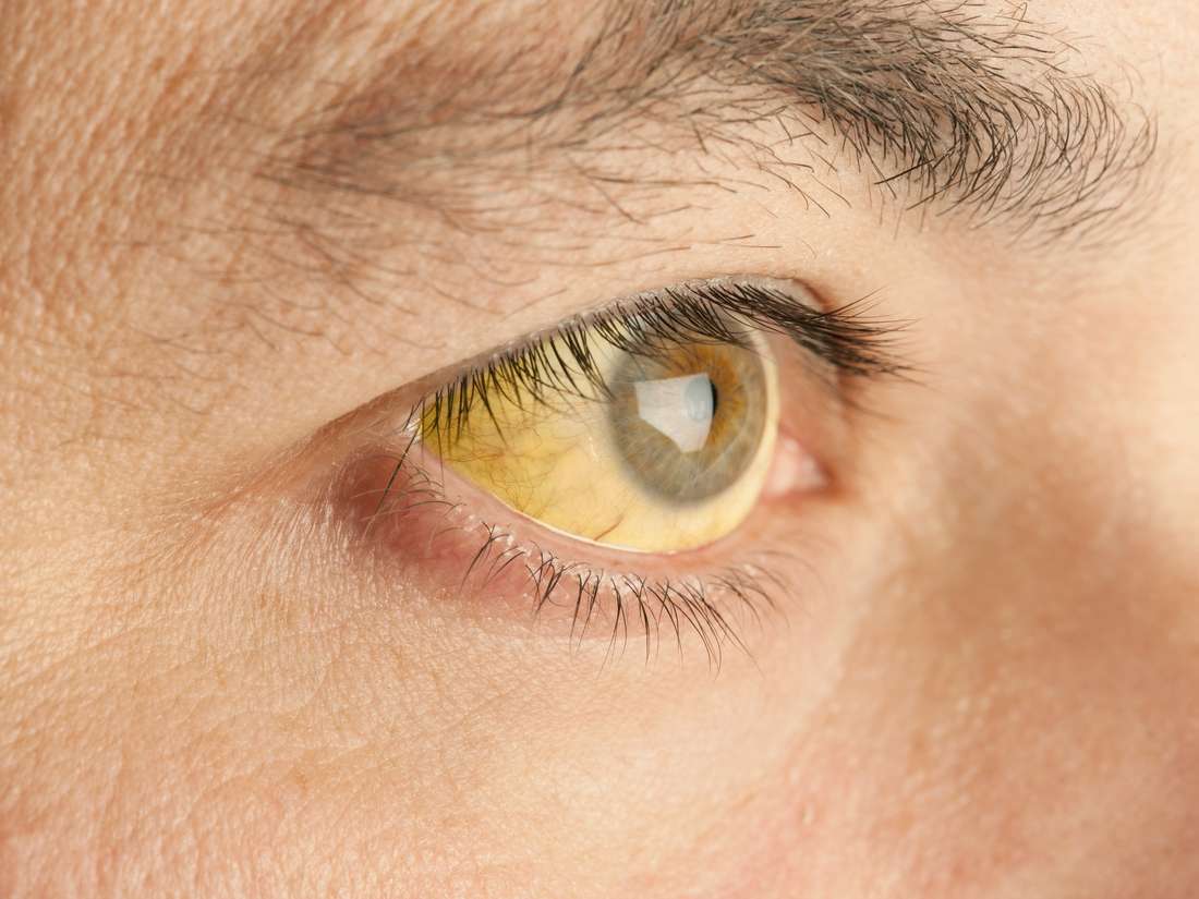 노란 눈(황달)의 원인과 극복 방법