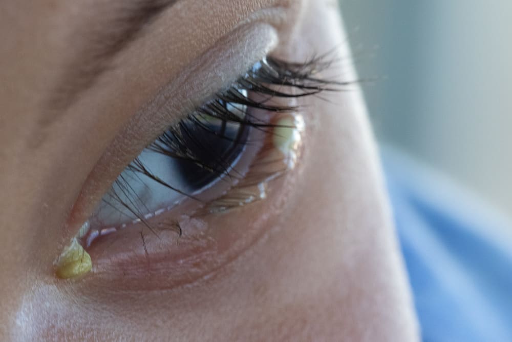 Verschiedene Ursachen für Belekan-Augen, auf die Sie achten sollten