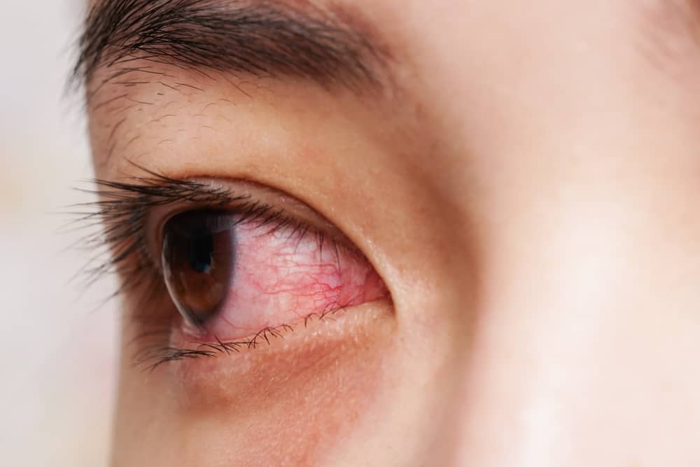 דרכים שונות להתגבר על עיניים אדומות מומלצות מבחינה רפואית