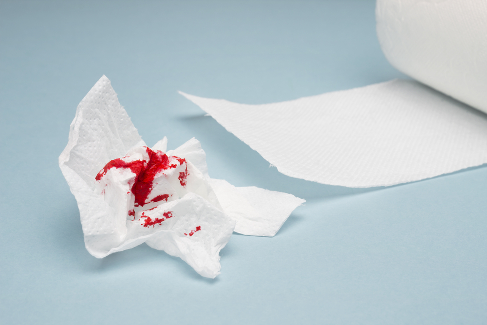 Lucruri pe care ar trebui să le știți despre hemoroizii rupți