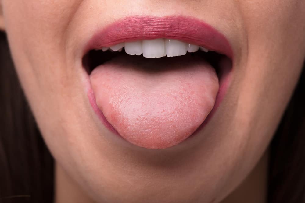 5 Ursachen für eine wunde Zunge, die von einem Arzt überprüft werden müssen