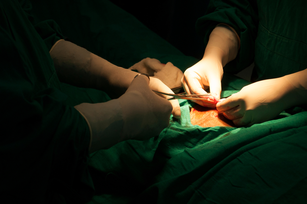 Revizuirea Tubectomiei, Procedura de sterilizare feminină pentru a preveni sarcina
