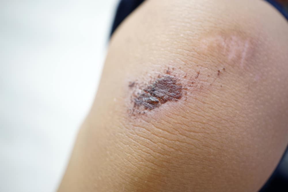 5 sfaturi pentru a scăpa de cicatrici pentru o piele netedă din nou