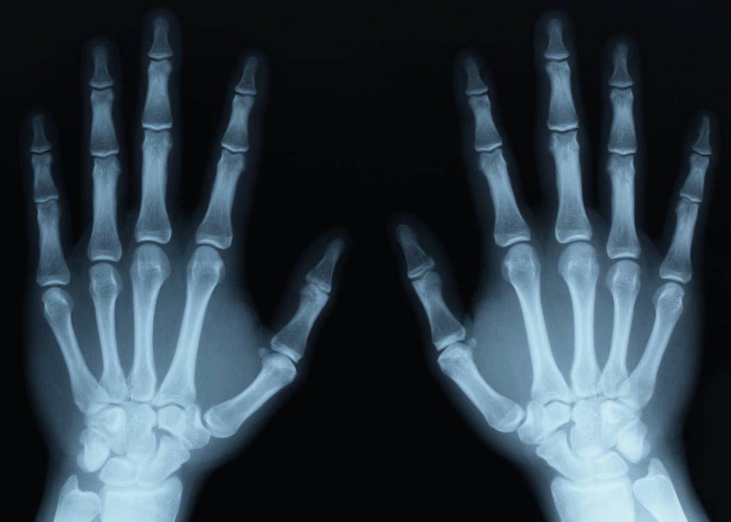 Lo que necesita saber antes de tomar radiografías