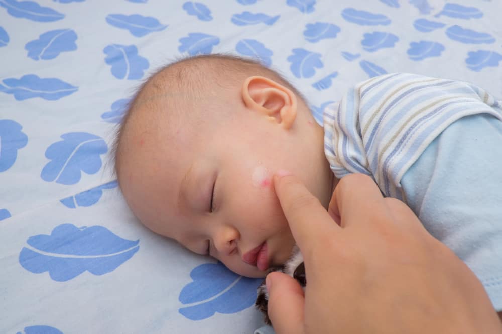 6 effektiva sätt att bli av med myggbett hos spädbarn