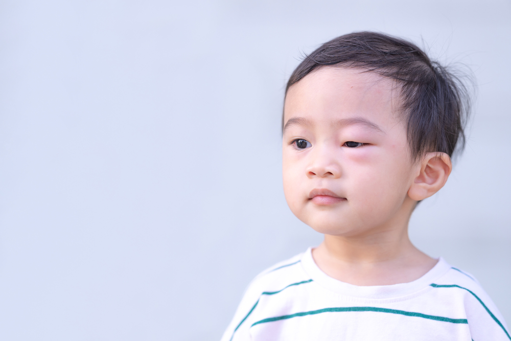 Обзор различных причин опухших глаз у детей и способы их лечения