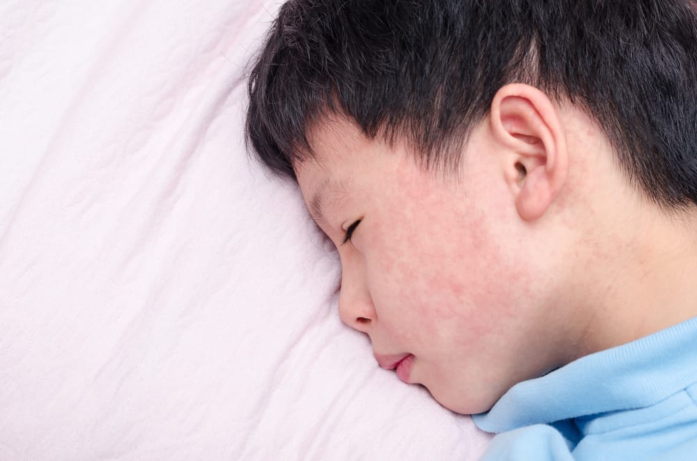 Reconocer las características del sarampión alemán (rubéola) que pueden atacar a los niños.