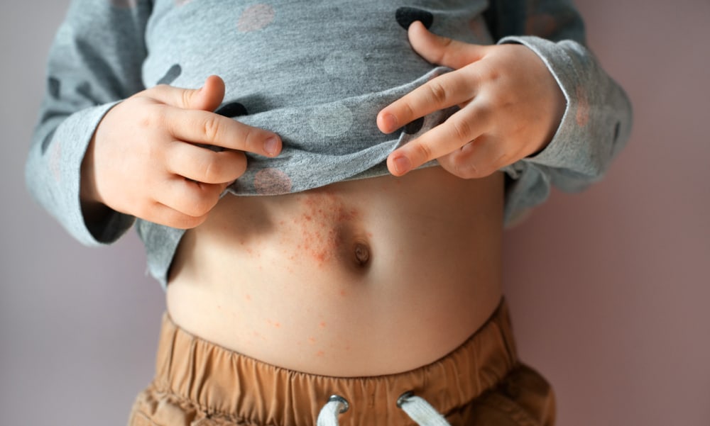 אבעבועות שחורות בילדים: גורמים, תסמינים, טיפול וכיצד למנוע אותה