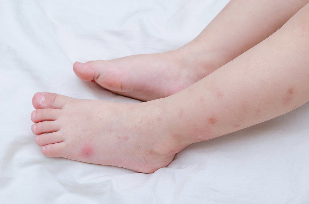 Atenție la simptomele febrei hemoragice dengue (DHF) la copii