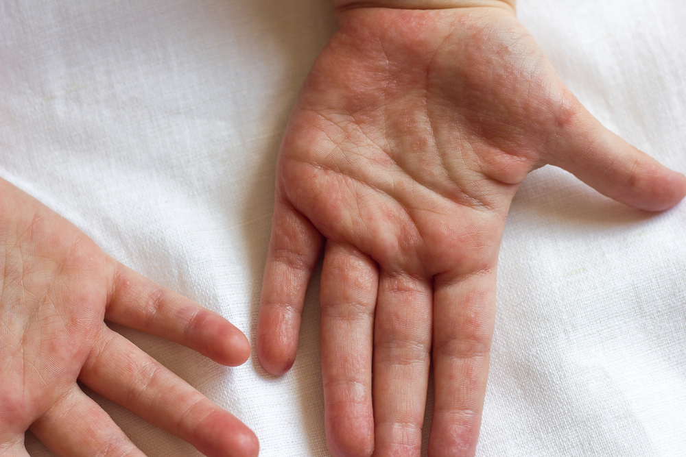גורמים וטיפול ב-Herpetic Whitlow, זיהום הרפס על האצבעות